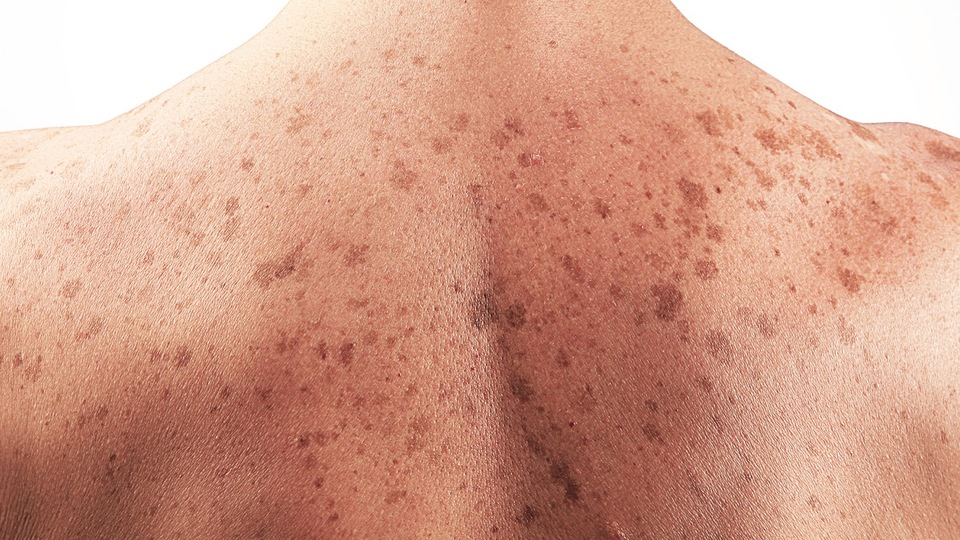 Uçuk virüsü cilt kanserine karşı