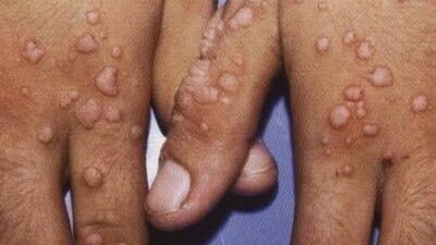 Siğillerin bulaşıcı olduğunu biliyor muydunuz?