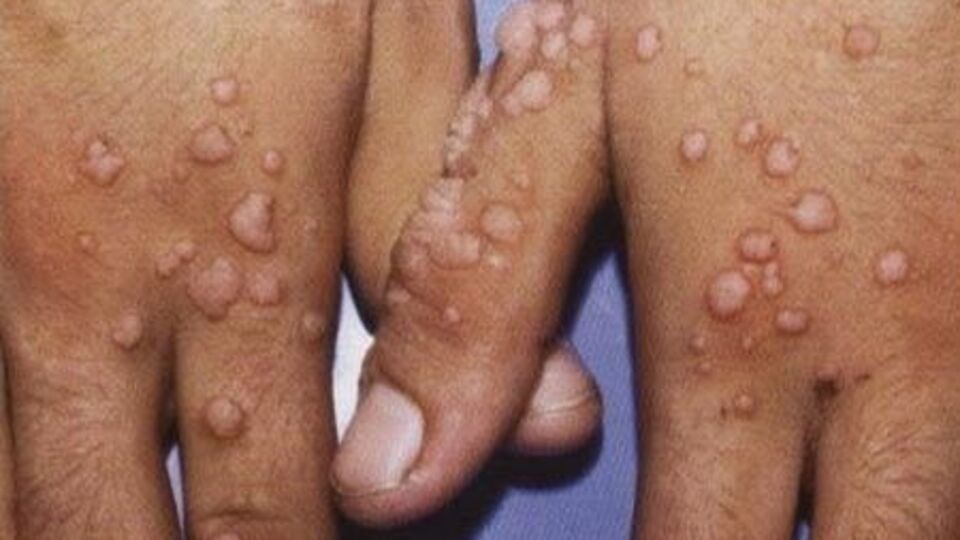 Siğillerin bulaşıcı olduğunu biliyor muydunuz?