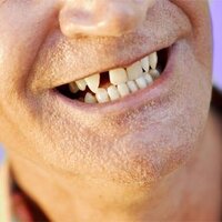 Diş eksikliği o hastalıkların habercisi!