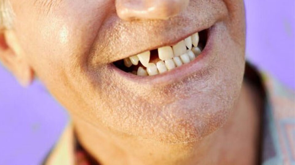 Diş eksikliği o hastalıkların habercisi!