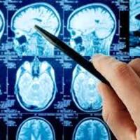 Beyin tümörü herkeste görülebiliyor!