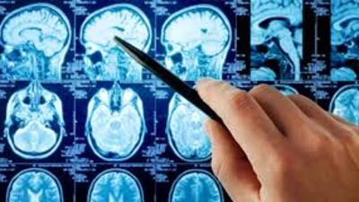 Beyin tümörü herkeste görülebiliyor!