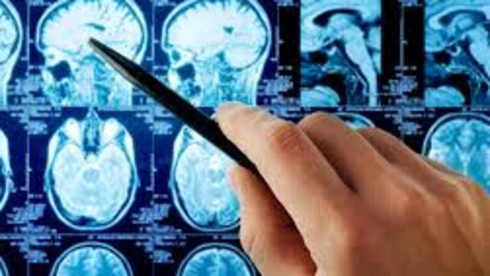 Beyin tümörü herkeste görülebiliyor!