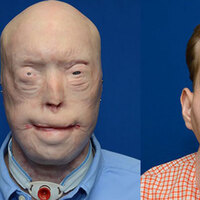 En kapsamlı yüz nakli ABD'de yapıldı