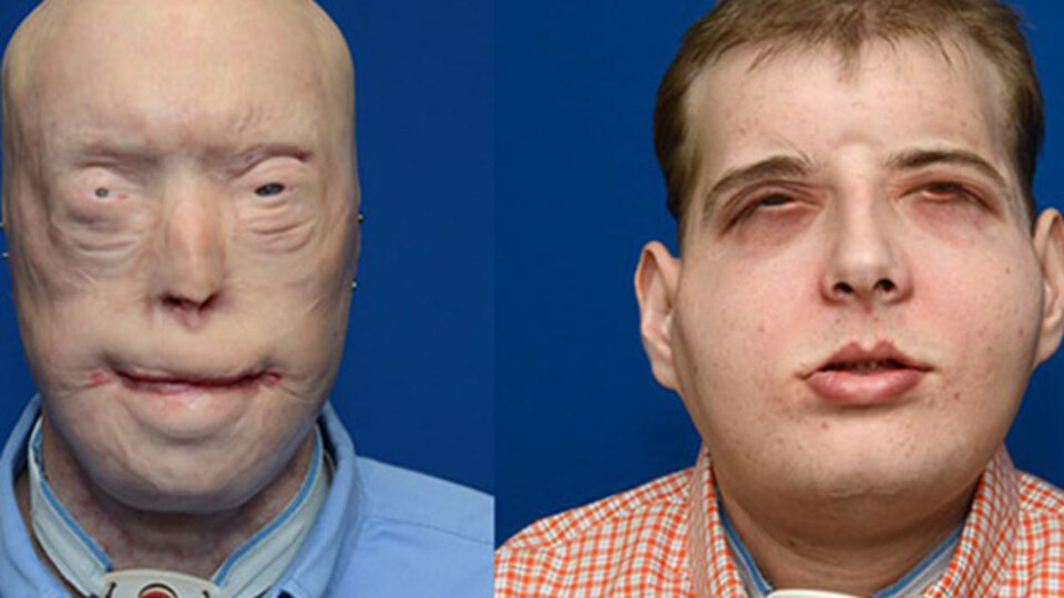 En kapsamlı yüz nakli ABD'de yapıldı