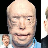 İşte dünyanın en başarılı yüz nakli