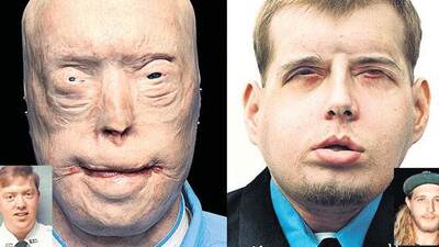 İşte dünyanın en başarılı yüz nakli