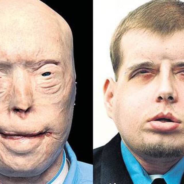 İşte dünyanın en başarılı yüz nakli