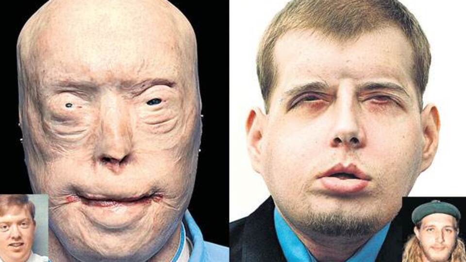 İşte dünyanın en başarılı yüz nakli