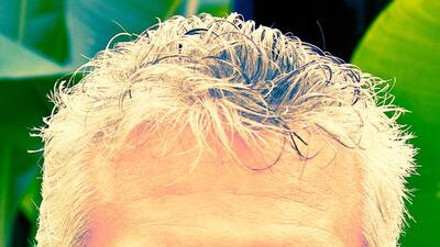 Saçlarınız beyazlıyorsa o hastalığa dikkat!