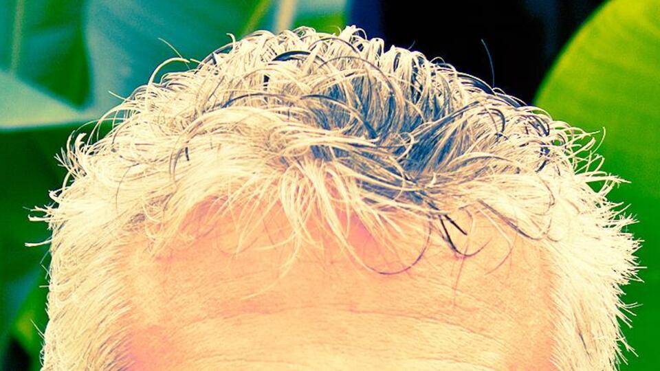 Saçlarınız beyazlıyorsa o hastalığa dikkat!