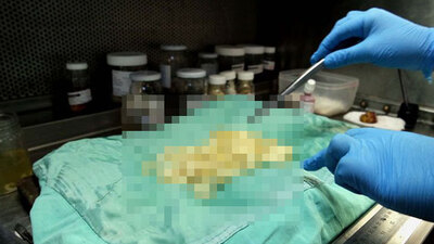 Ameliyatta fark edildi, doktorlar bile şoke oldu!