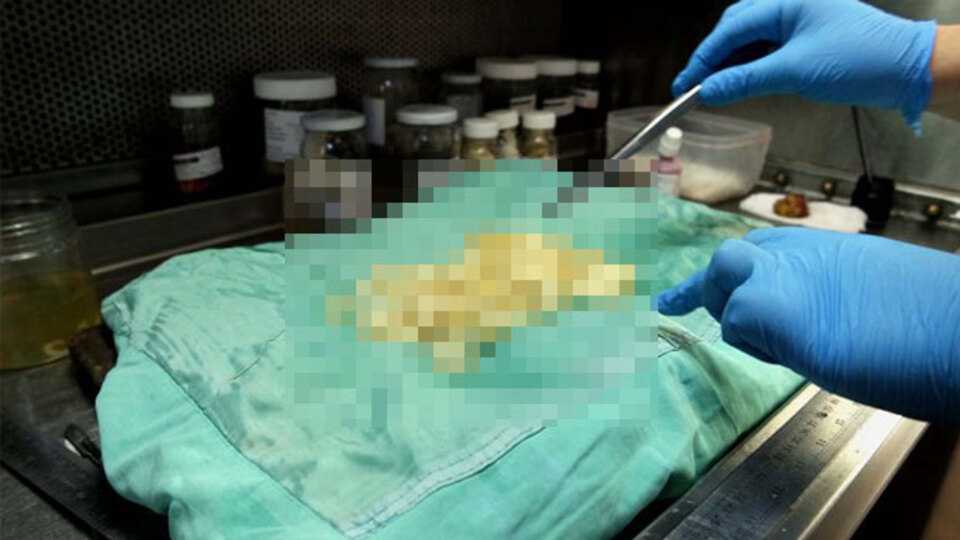 Ameliyatta fark edildi, doktorlar bile şoke oldu!