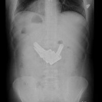 Midesi ve bağırsağından 13 kalem pil çıktı