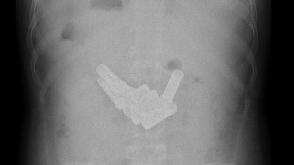 Midesi ve bağırsağından 13 kalem pil çıktı