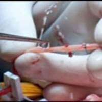 İlk defa yapay damar ameliyatı gerçekleştirildi!