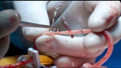 İlk defa yapay damar ameliyatı gerçekleştirildi!