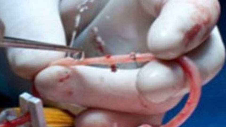 İlk defa yapay damar ameliyatı gerçekleştirildi!