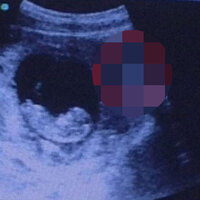 Ultrasondaki ayrıntı şoke etti!