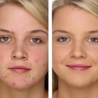 Sivilce izlerinden böyle kurtulun!