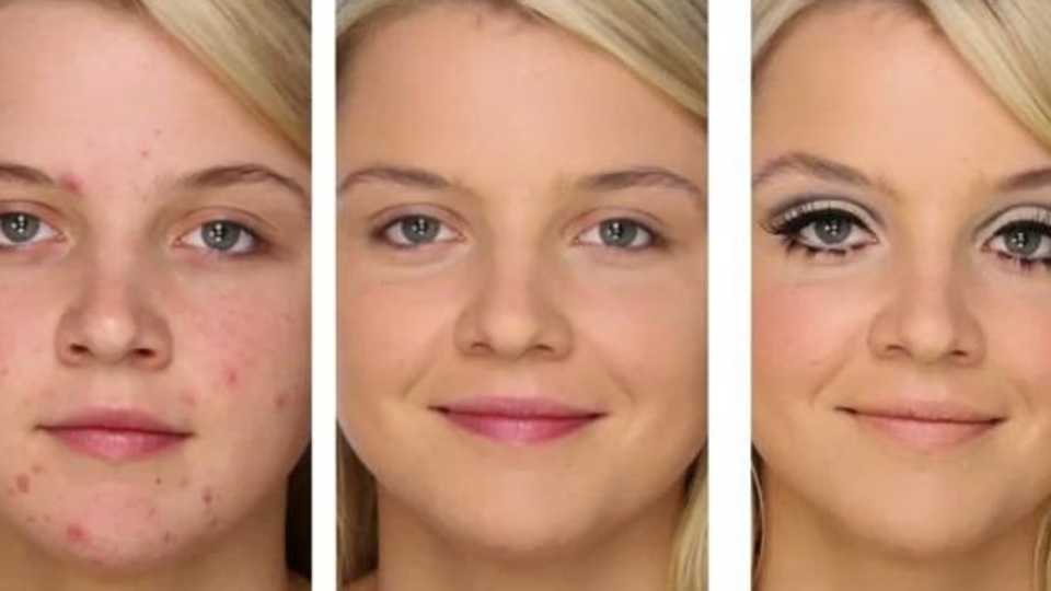 Sivilce izlerinden böyle kurtulun!