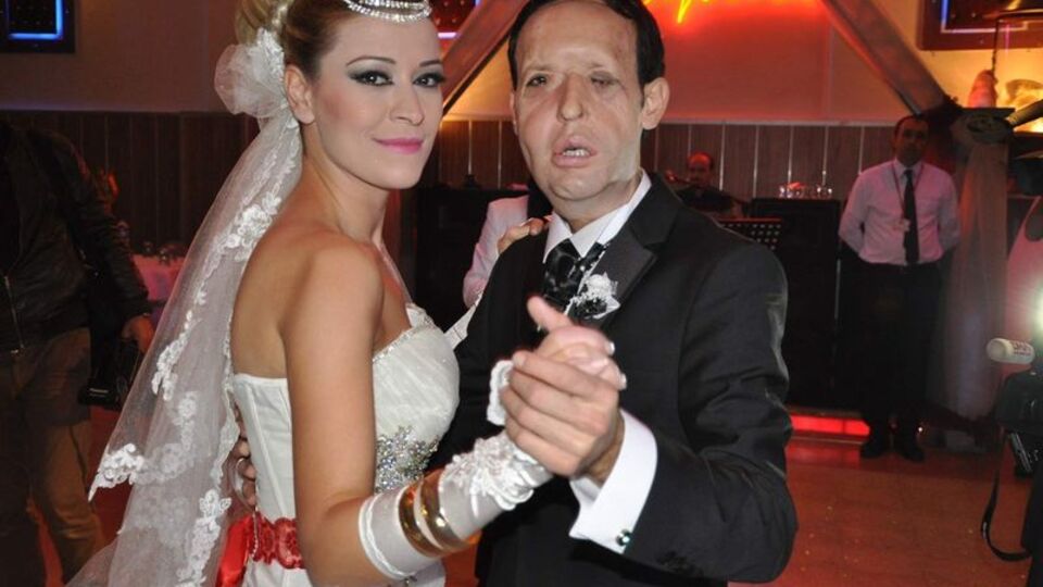 Türkiye'de 5. yüz nakli yapılan Recep Sert, baba oldu