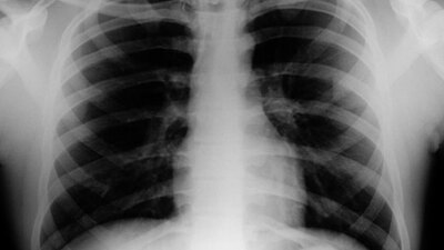 SGK, sigara içenlerin kanser ilacını ödemeyecek!