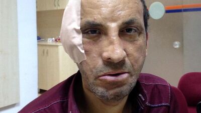 Yüz nakilli Uğur Acar'a, estetik müdahale!