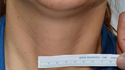 'Her tiroid nodülü kanser değil'