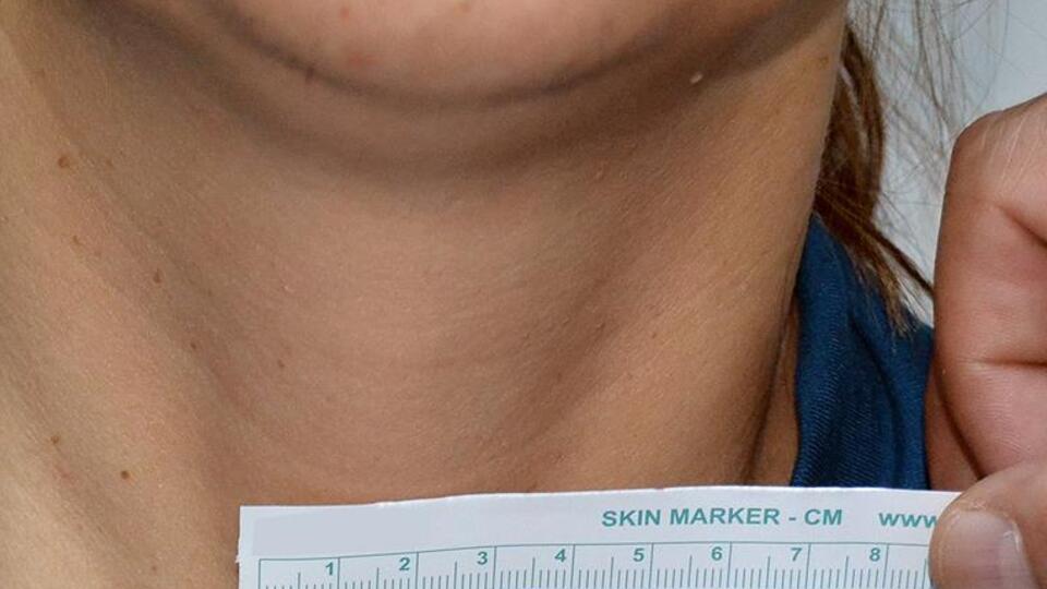 'Her tiroid nodülü kanser değil'