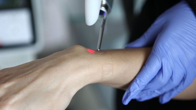 Lazer epilasyon merdivenaltına düştü