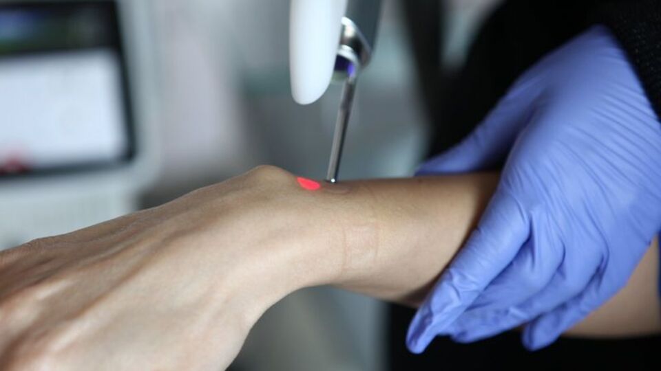 Lazer epilasyon merdivenaltına düştü