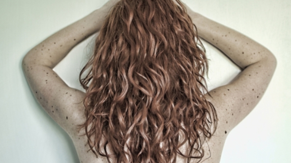 Vücudunuzdaki benleri sayın! Eğer 50'den fazla varsa...