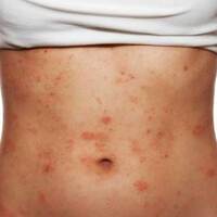 Gül hastalığı bahar aylarında daha çok görülüyor!