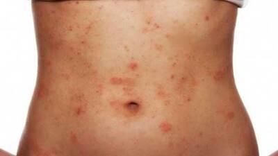 Gül hastalığı bahar aylarında daha çok görülüyor!