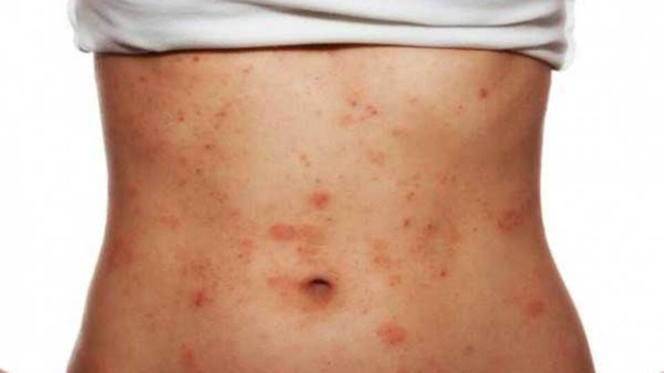 Gül hastalığı bahar aylarında daha çok görülüyor!