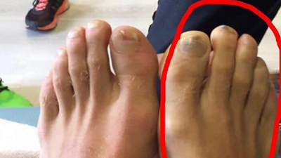 Töre'den sakatlık açıklaması