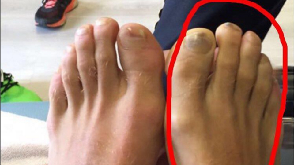 Töre'den sakatlık açıklaması