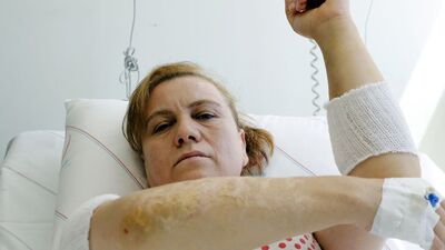 Talihsiz kadının yanıkları ithal edilen bantlarla tedavi edilecek!