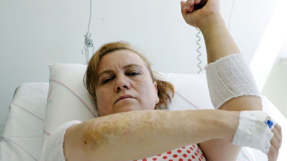 Talihsiz kadının yanıkları ithal edilen bantlarla tedavi edilecek!