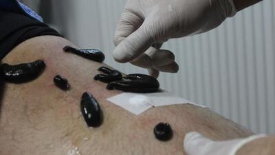 Sülük tedavisindeki tehlike!