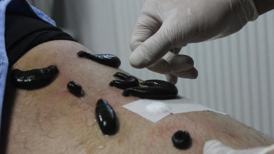 Sülük tedavisindeki tehlike!