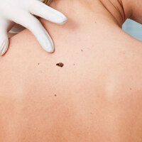 Eğer vücudunuzdaki benler büyüyorsa...