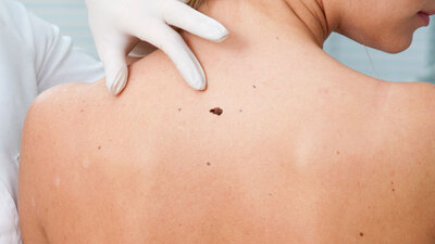 Eğer vücudunuzdaki benler büyüyorsa...