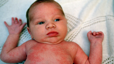 Çocuklarda alerji testleri