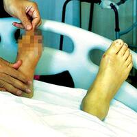 Diyabetli hastalarda ayak kontrolü şart!