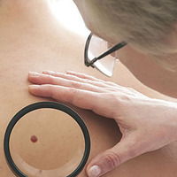 Yeni çıkan benler farkediyorsanız...