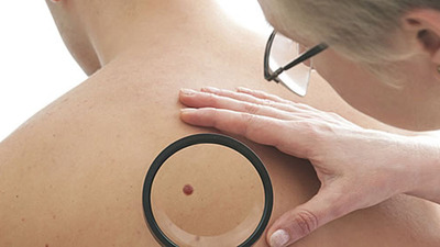 Yeni çıkan benler farkediyorsanız...