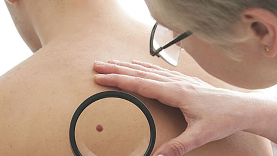 Yeni çıkan benler farkediyorsanız...